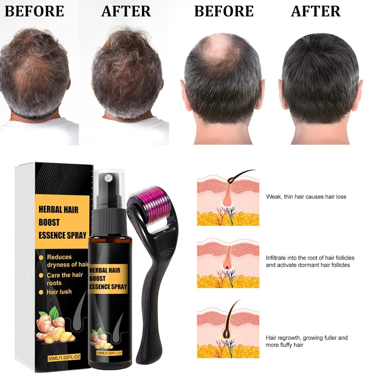 Kit de tratamiento avanzado para el crecimiento del cabello 30ml 2PCS Spray para el crecimiento del cabello Juego de esencia y rodillo para el crecimiento del cabello Suero para el crecimiento del cabello Anticaída Suero avanzado para el crecimiento del cabello Cuidado del cabello Naty Shop