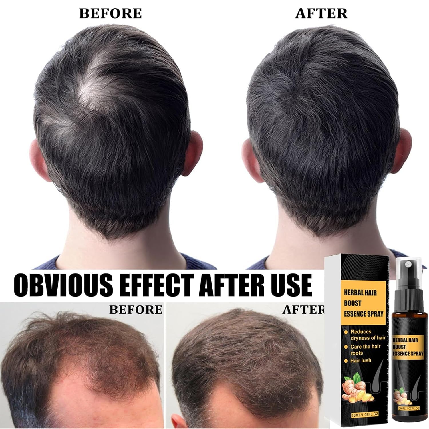 Kit de tratamiento avanzado para el crecimiento del cabello 30ml 2PCS Spray para el crecimiento del cabello Juego de esencia y rodillo para el crecimiento del cabello Suero para el crecimiento del cabello Anticaída Suero avanzado para el crecimiento del cabello Cuidado del cabello Naty Shop